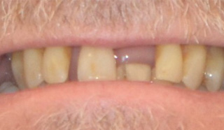 TeethXpress Before Photo