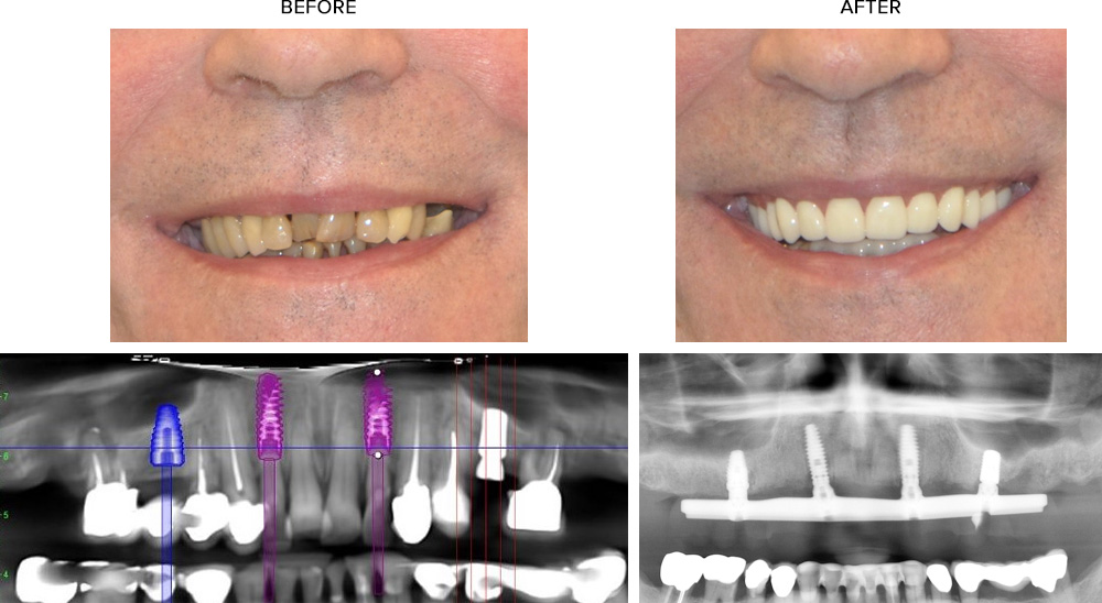 TeethXpress Before and After Case Study #1