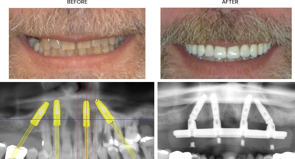 TeethXpress Before and After Case Study #2