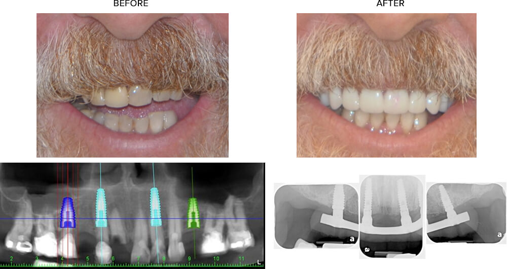 TeethXpress Before and After Case Study #3
