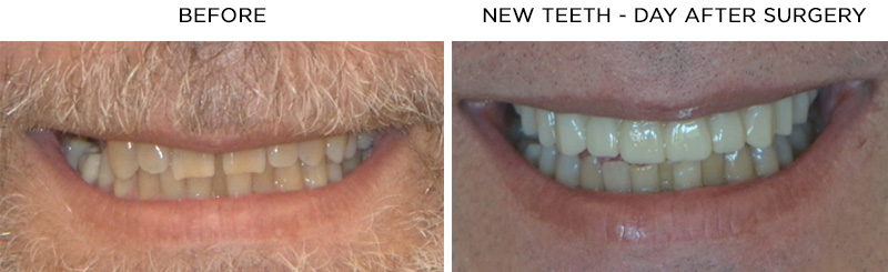 TeethXpress Before and After Surgery