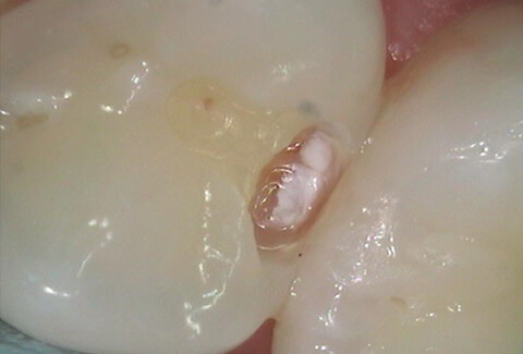 Tooth hole white