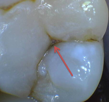 Tooth with cavity