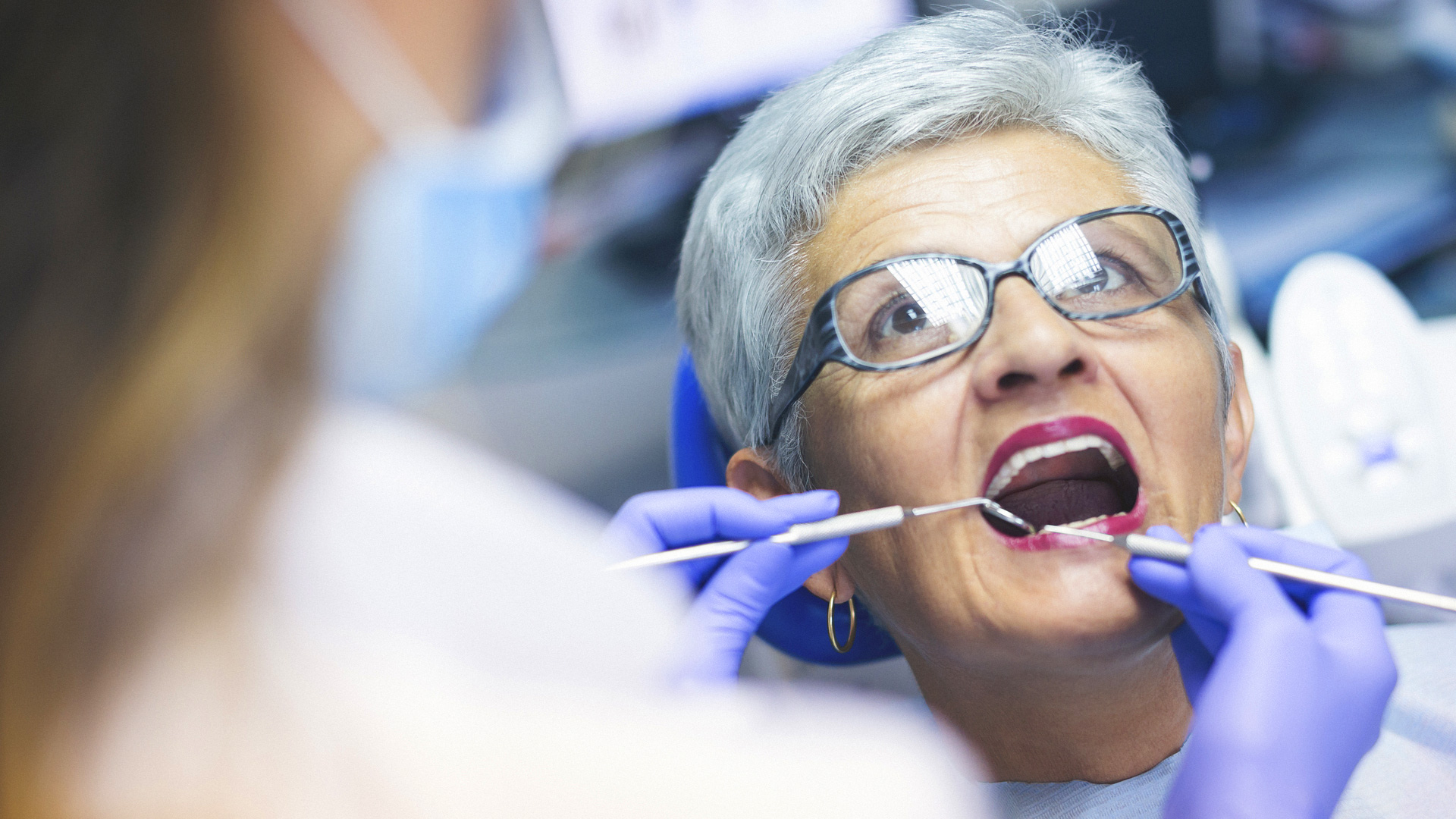 Tooth-Colored Fillings