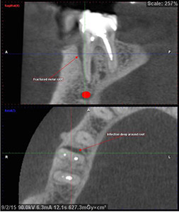 Tooth Diagnosis Root Fracture