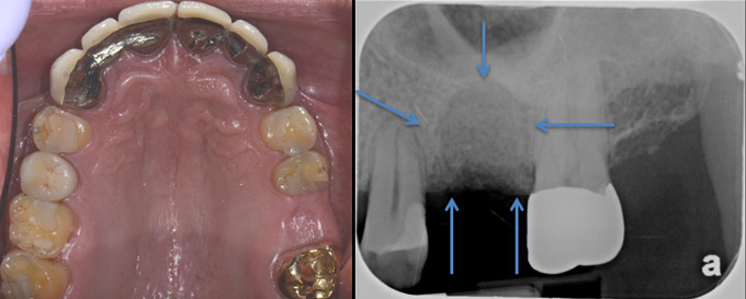 Tooth is removed and a bone graft placed in preparation of implant