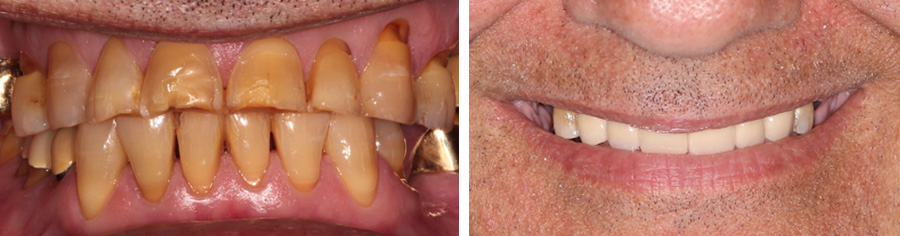 Tooth wear before and after