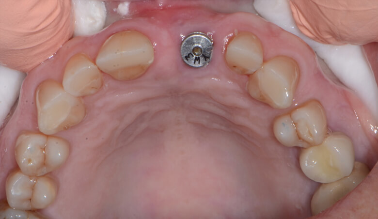 Teeth repaired with tooth-colored composite