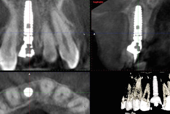 Two Month CT Scan