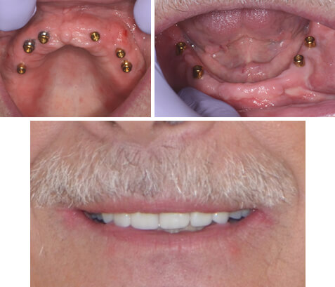 Upper and lower implant dentures after