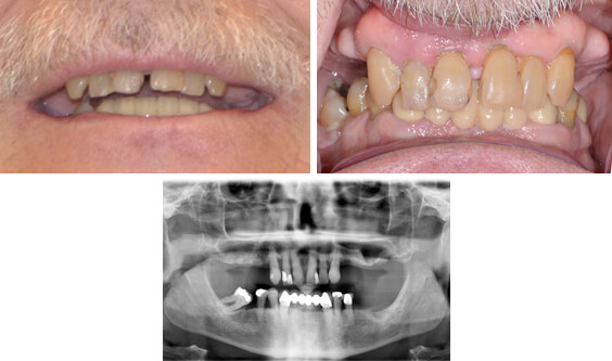 Upper and lower implant dentures before