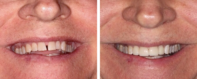 Veneers Before and After