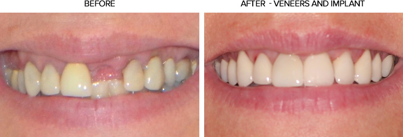 Veneers Before and After