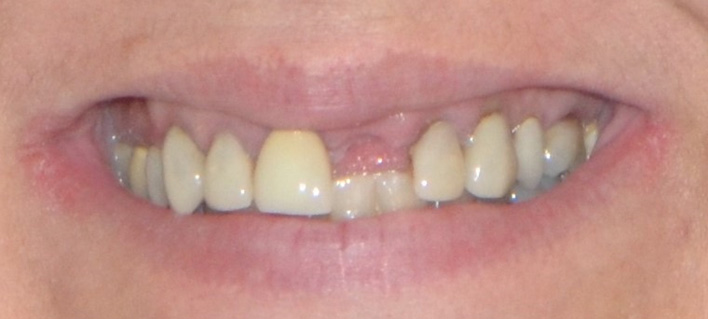 Veneers and dental implants