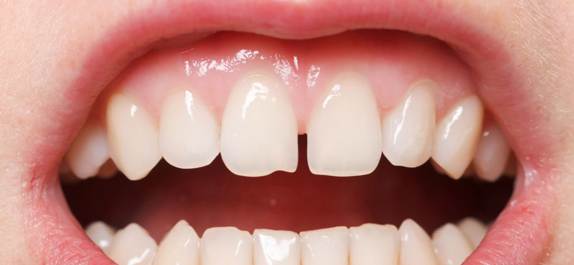 How to Fill Gaps Between Teeth: Your Guide to Diastema