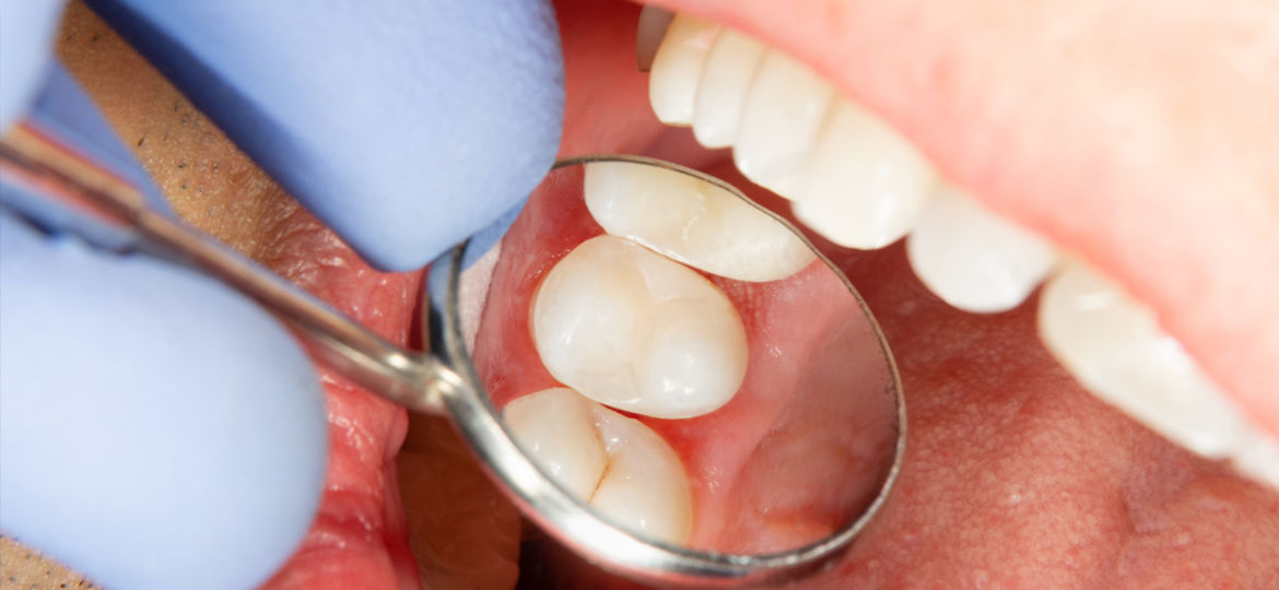 What is a root canal?