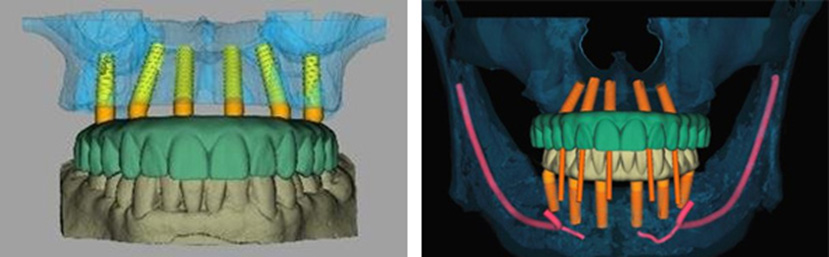 TeethXpress Dental Implants