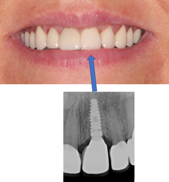 Which tooth is the implant?