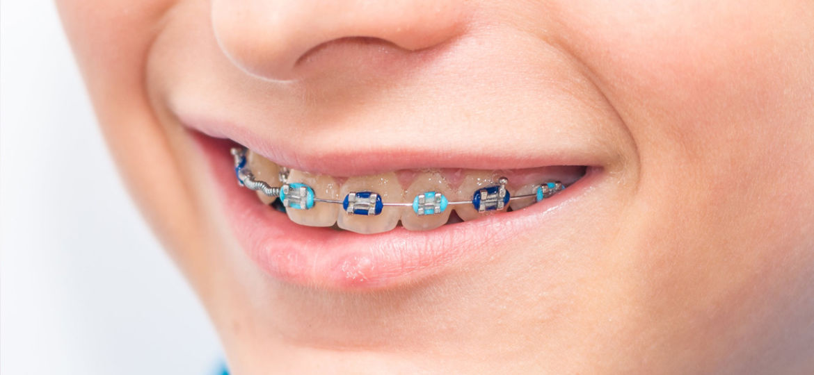 Do You Have Bad “White Spots” or Tooth Discoloration From Braces?