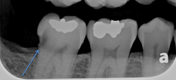 Wisdom Teeth Causing a Cavity