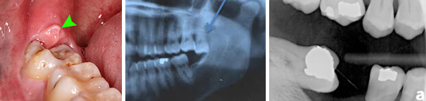 Problems with Wisdom Teeth