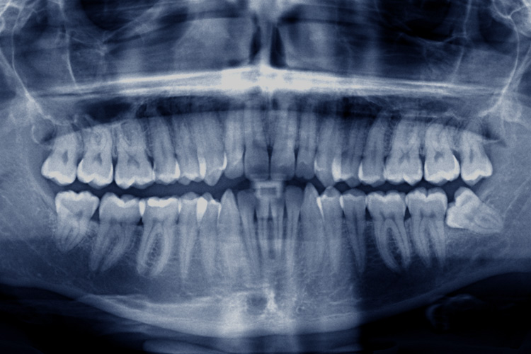 Oral Surgery and Wisdom Teeth