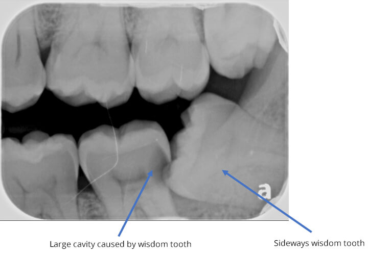 X-ray of cavity caused by wisdom tooth