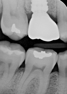 X-Ray of Dental Implant