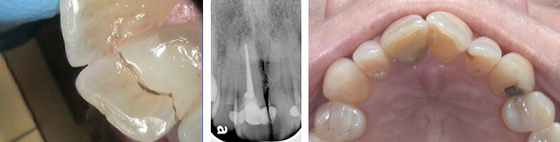 Broken front tooth before surgery