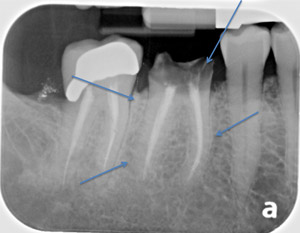 X-ray broken tooth