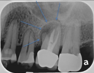 X-ray of painful infected molar tooth